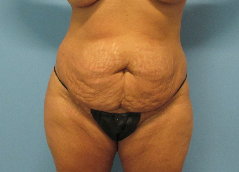 Tummy Tuck Before and After | SGK Plastic Surgery