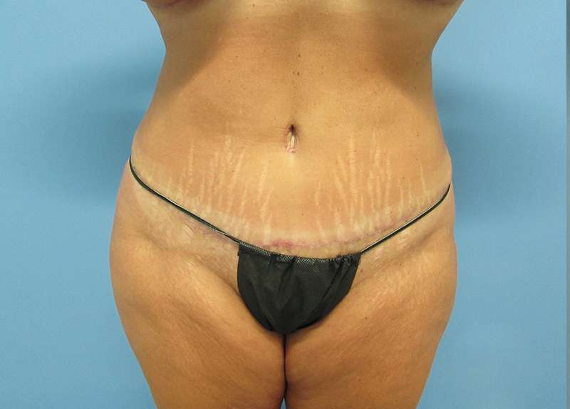 Tummy Tuck Before and After | SGK Plastic Surgery