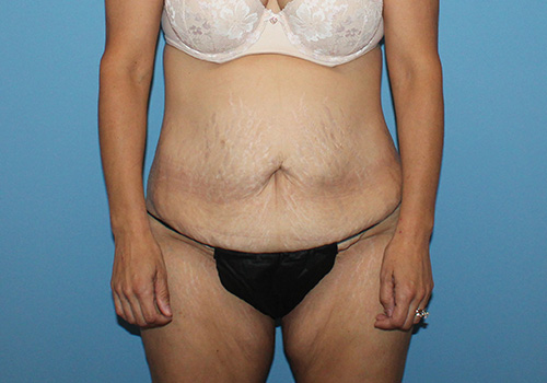 Tummy Tuck Before and After | SGK Plastic Surgery