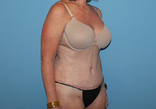 Tummy Tuck Before and After | SGK Plastic Surgery