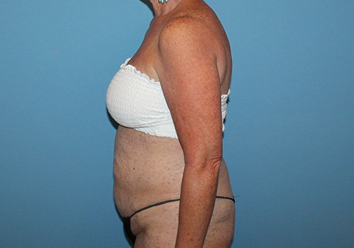 Tummy Tuck Before and After | SGK Plastic Surgery