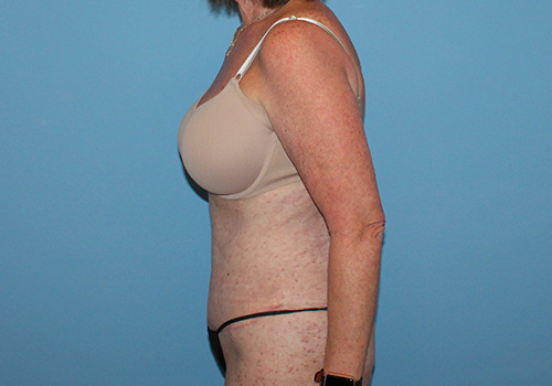 Tummy Tuck Before and After | SGK Plastic Surgery
