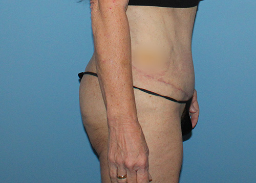 Tummy Tuck Before and After | SGK Plastic Surgery