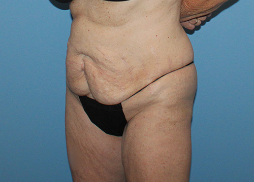 Tummy Tuck Before and After | SGK Plastic Surgery