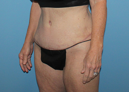 Tummy Tuck Before and After | SGK Plastic Surgery