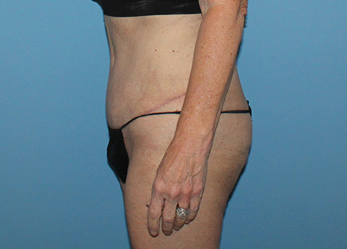 Tummy Tuck Before and After | SGK Plastic Surgery