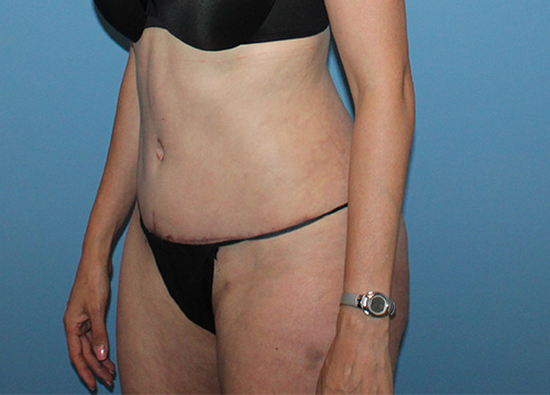 Tummy Tuck Before and After | SGK Plastic Surgery