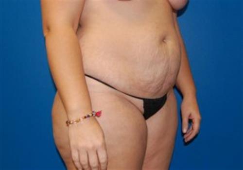 Tummy Tuck Before and After | SGK Plastic Surgery