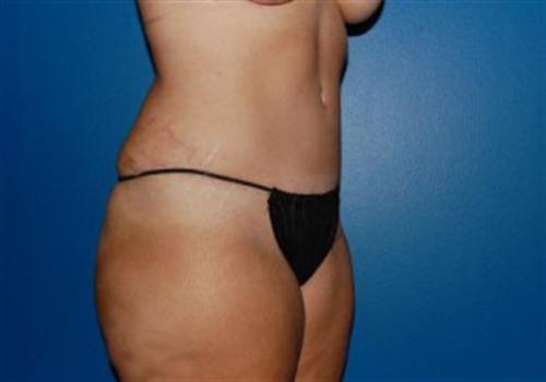 Tummy Tuck Before and After | SGK Plastic Surgery