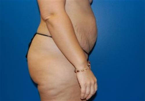 Tummy Tuck Before and After | SGK Plastic Surgery