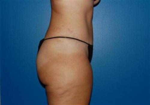 Tummy Tuck Before and After | SGK Plastic Surgery