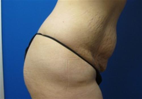 Tummy Tuck Before and After | SGK Plastic Surgery