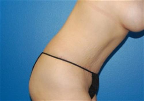 Tummy Tuck Before and After | SGK Plastic Surgery