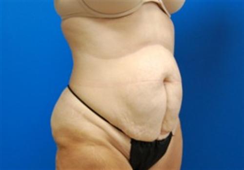 Tummy Tuck Before and After | SGK Plastic Surgery