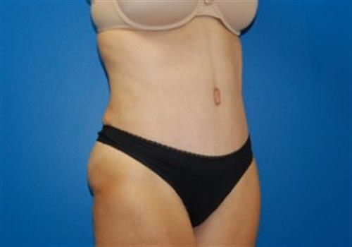 Tummy Tuck Before and After | SGK Plastic Surgery