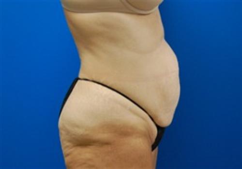 Tummy Tuck Before and After | SGK Plastic Surgery