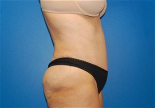 Tummy Tuck Before and After | SGK Plastic Surgery