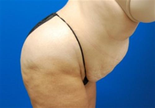 Tummy Tuck Before and After | SGK Plastic Surgery