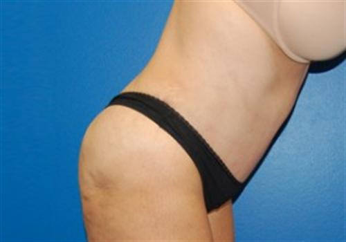 Tummy Tuck Before and After | SGK Plastic Surgery