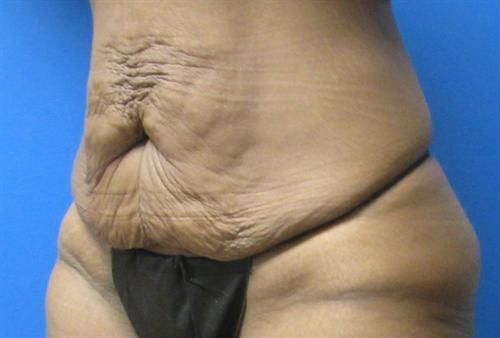Tummy Tuck Before and After | SGK Plastic Surgery