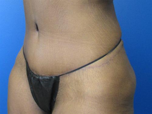 Tummy Tuck Before and After | SGK Plastic Surgery