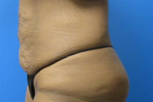 Tummy Tuck Before and After | SGK Plastic Surgery