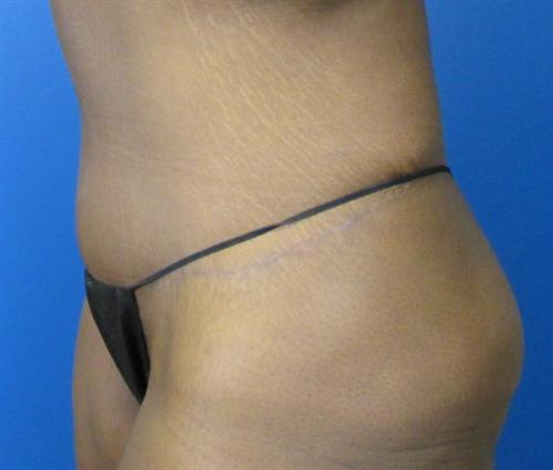 Tummy Tuck Before and After | SGK Plastic Surgery