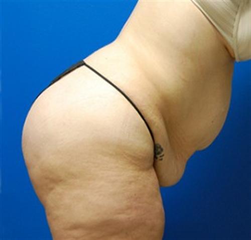 Tummy Tuck Before and After | SGK Plastic Surgery