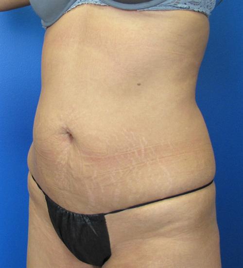Tummy Tuck Before and After | SGK Plastic Surgery