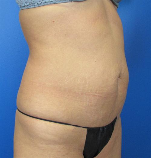 Tummy Tuck Before and After | SGK Plastic Surgery