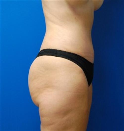 Tummy Tuck Before and After | SGK Plastic Surgery