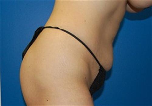 Tummy Tuck Before and After | SGK Plastic Surgery