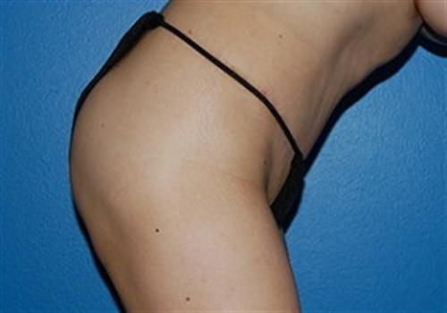 Tummy Tuck Before and After | SGK Plastic Surgery