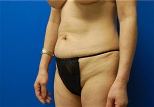 Tummy Tuck Before and After | SGK Plastic Surgery