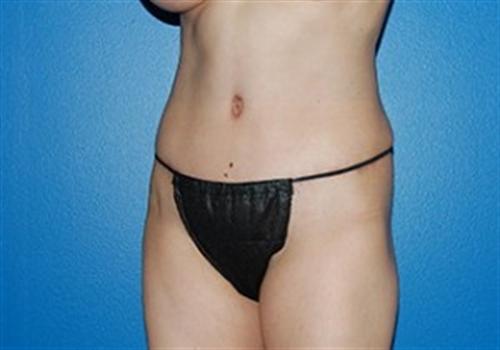Tummy Tuck Before and After | SGK Plastic Surgery
