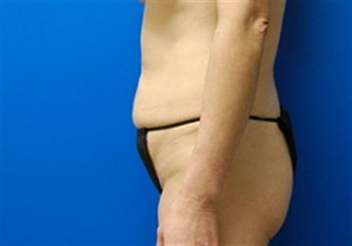 Tummy Tuck Before and After | SGK Plastic Surgery