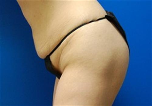 Tummy Tuck Before and After | SGK Plastic Surgery