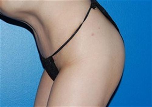 Tummy Tuck Before and After | SGK Plastic Surgery