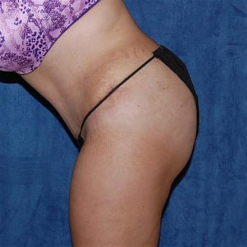 Tummy Tuck Before and After | SGK Plastic Surgery