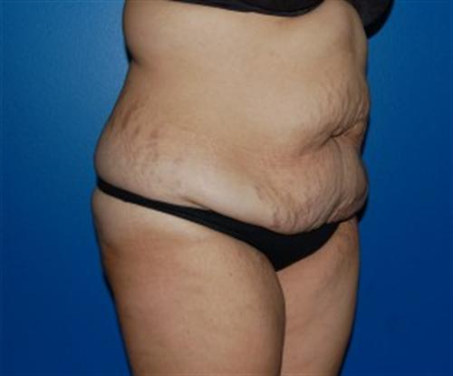 Tummy Tuck Before and After | SGK Plastic Surgery