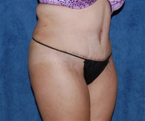 Tummy Tuck Before and After | SGK Plastic Surgery