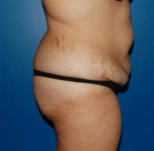 Tummy Tuck Before and After | SGK Plastic Surgery