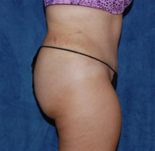 Tummy Tuck Before and After | SGK Plastic Surgery