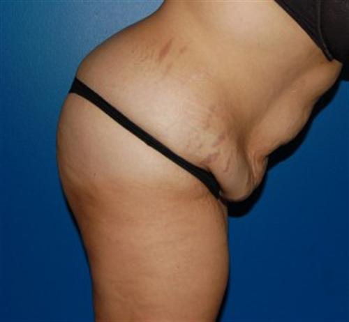 Tummy Tuck Before and After | SGK Plastic Surgery