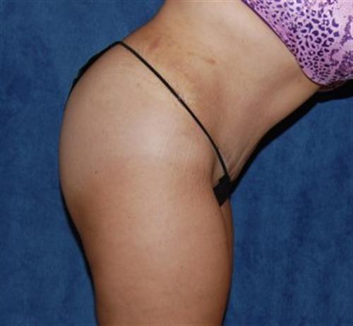 Tummy Tuck Before and After | SGK Plastic Surgery