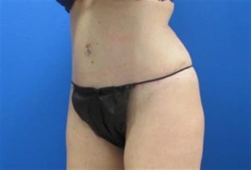 Tummy Tuck Before and After | SGK Plastic Surgery