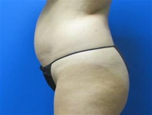 Tummy Tuck Before and After | SGK Plastic Surgery