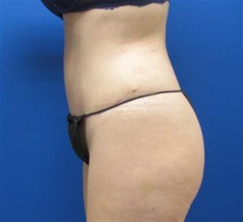 Tummy Tuck Before and After | SGK Plastic Surgery