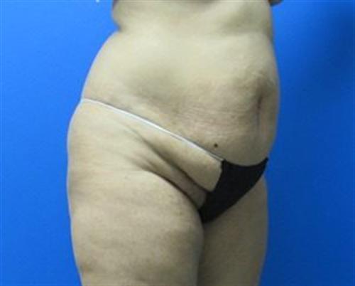 Tummy Tuck Before and After | SGK Plastic Surgery
