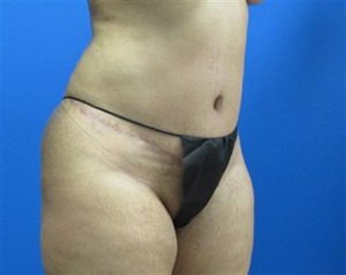 Tummy Tuck Before and After | SGK Plastic Surgery